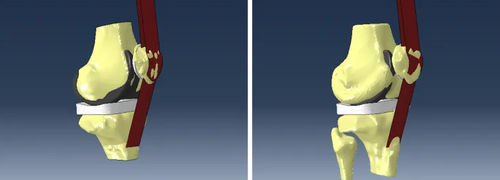 Analysesoftware - Abaqus Knee Simulator - SIMULIA - Simulation / Modellierung / Projektentwicklung
