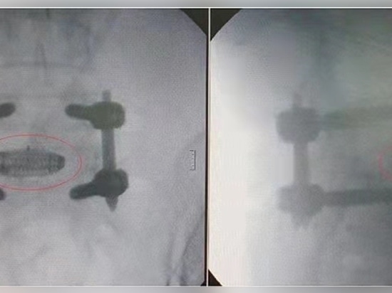 Herstellung von Wirbelsäulenimplantaten mit dem EP-M250 Metall-3D-Drucker